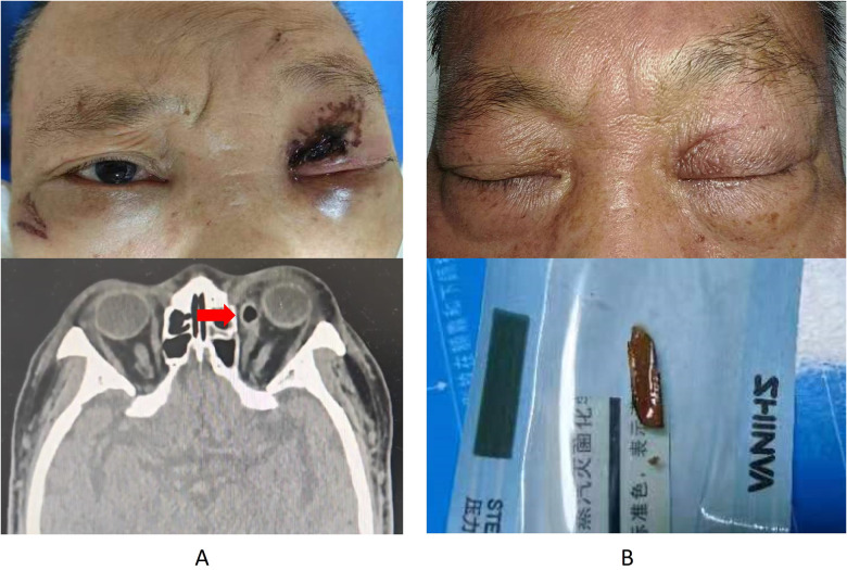 Clinical photograph of the inflamed left eye with purulent discharge at the medial canthus, alongside CT reconstructions in oblique sagittal, coronal and horizontal planes showing the full length of the foreign body