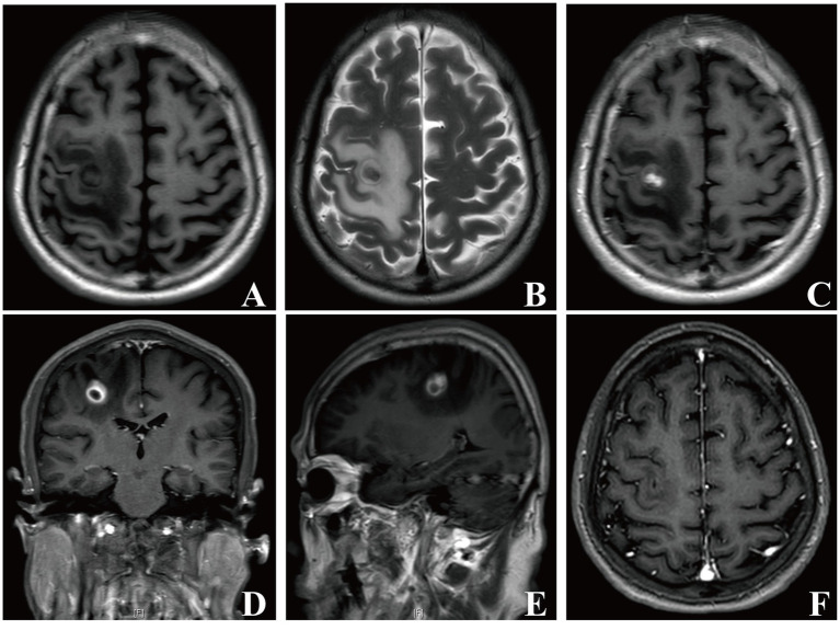 Six MRI panels of a brain abscess in the right frontal lobe. The upper row shows the lesion with surrounding swelling. The lower row shows a bright enhancing ring around a dark centre on coronal and sagittal views. The final panel, taken a month after treatment, shows the lesion has gone