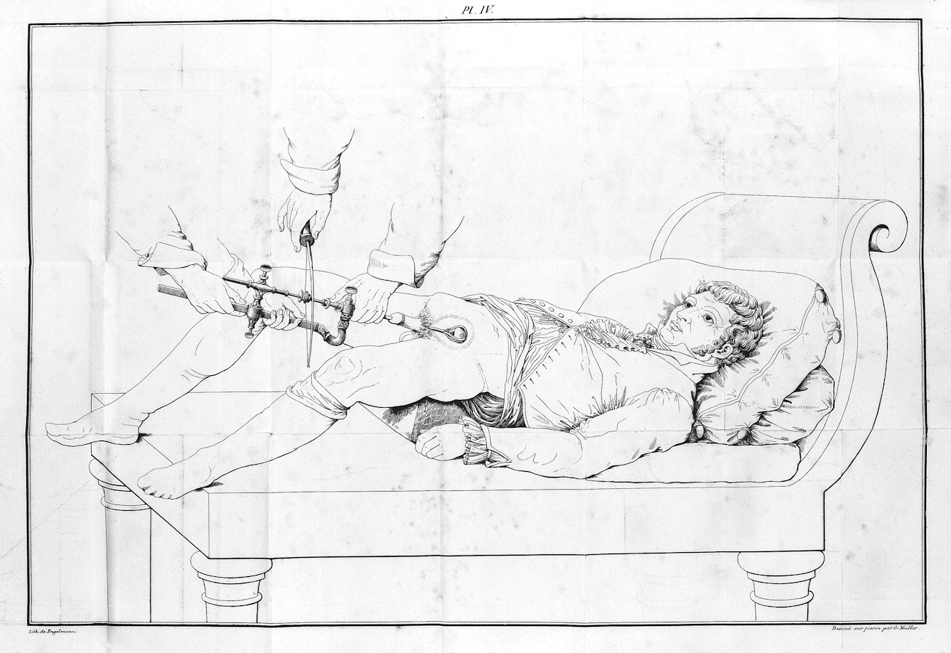 Nineteenth-century lithograph showing Civiale's lithotrity operation: a patient lies awake on a couch while three pairs of hands operate the lithotriteur passed through the urethra