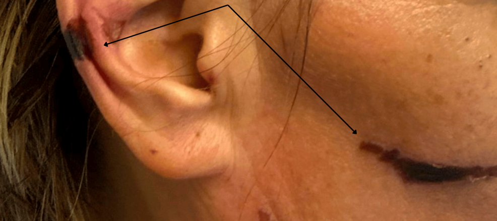 Close-up of an ear and cheek. Arrows mark two small dark non-blanching purpuric lesions, one on the helix of the ear and one on the cheek