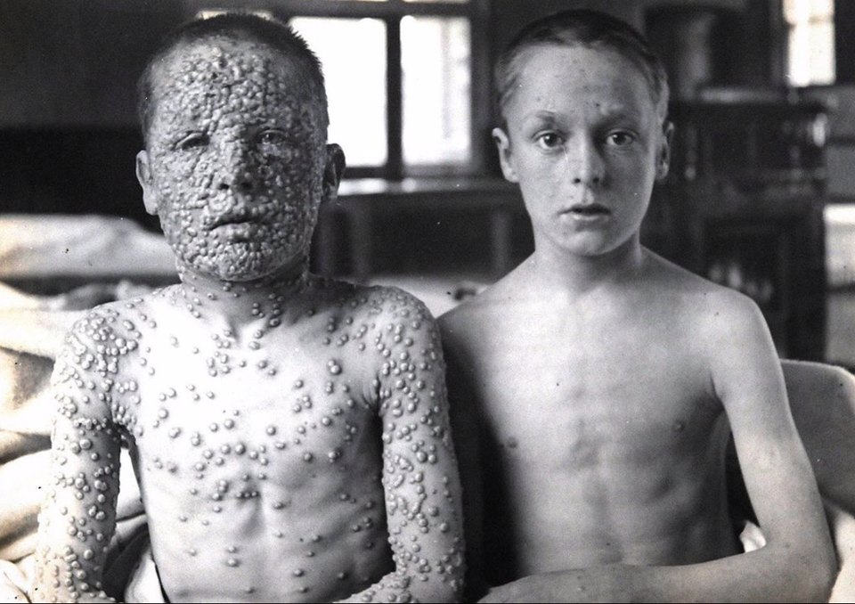 Two boys of thirteen photographed together in a hospital ward in 1901. The boy on the left, unvaccinated, is covered in raised pustules over his face, chest and arms. The boy on the right, vaccinated in infancy, has clear skin apart from a few faint marks.